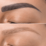 XtractInk tattoo removal results