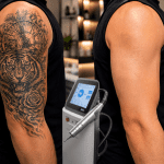 Tattoo ink removal XtractInk skin fading treatment results
