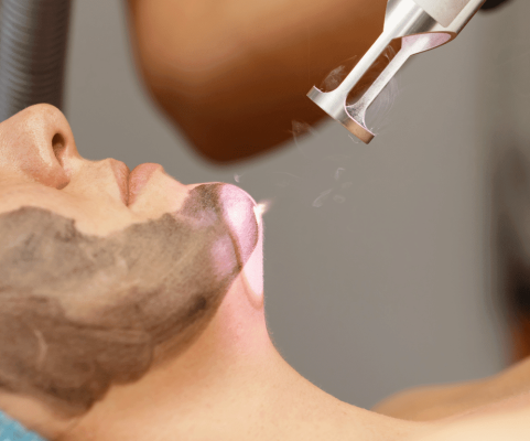 Laser Carbon Facial