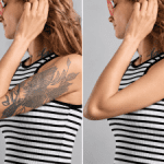 laser tattoo removal before and after result
