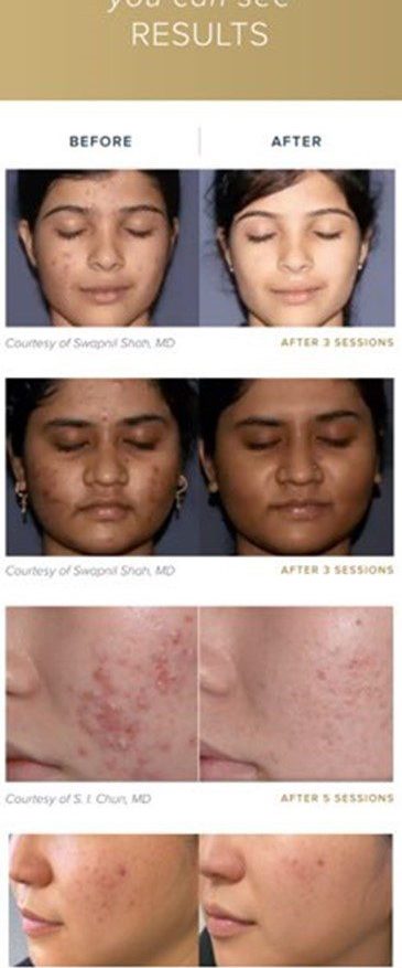 After before Acne Peel