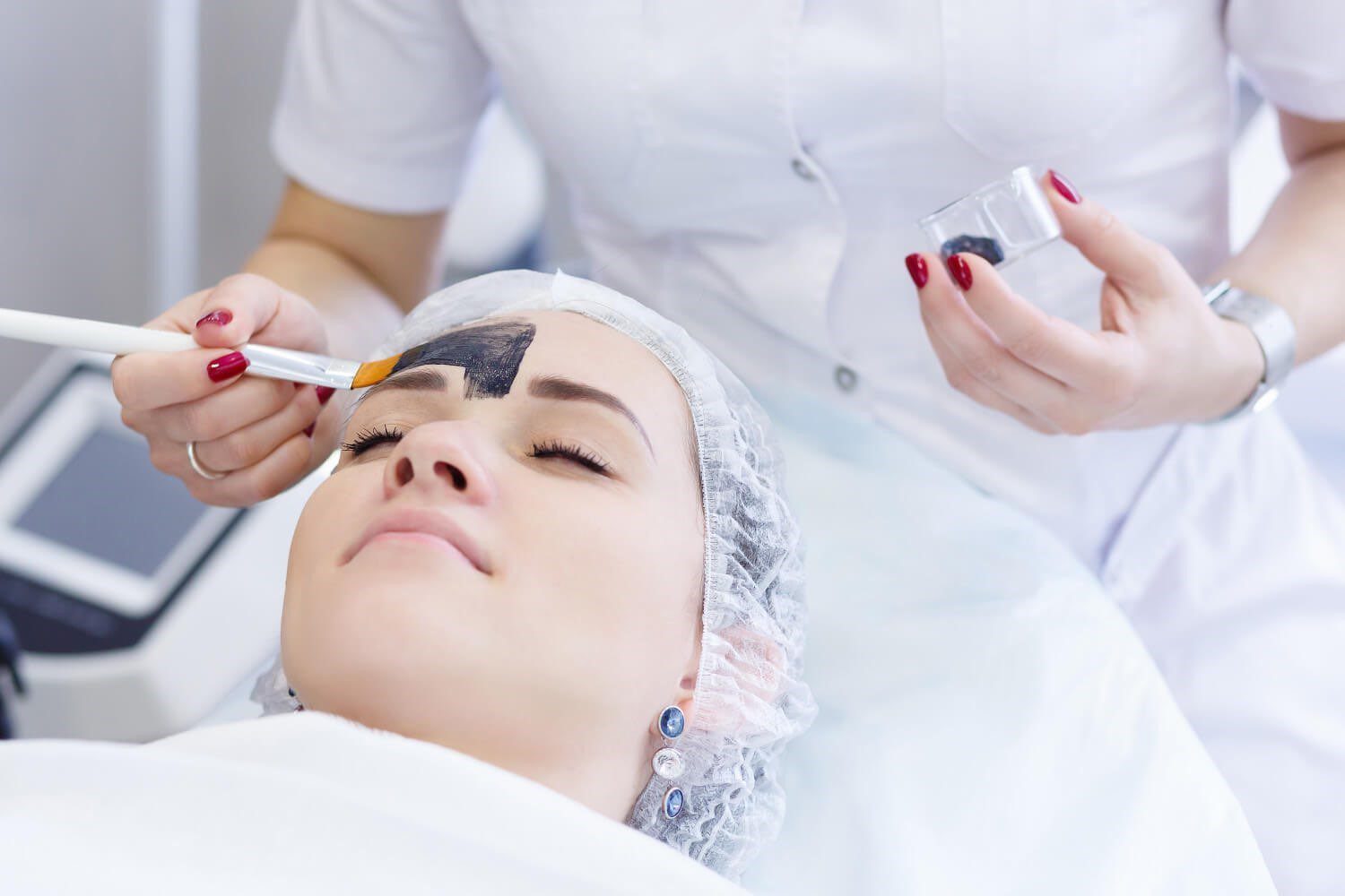 acne peel