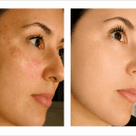 Hollywood Laser Peel treatment results