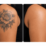 laser tattoo removal skin transformation