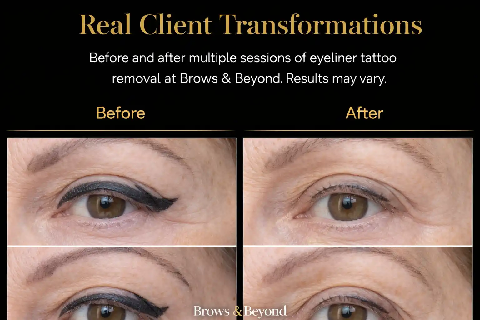 After laser eyeliner removal at Brows and Beyond Auckland — clean lash line, no pigment visible