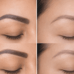 Before and after eyebrow pigment removal results