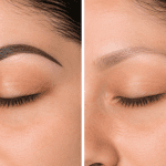 Eyebrow tattoo removal before and after results