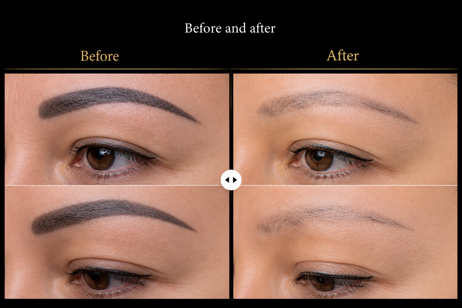 Eyebrow tattoo removal before and after results at Brows & Beyond NZ