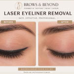 Laser eyeliner tattoo removal before and after results