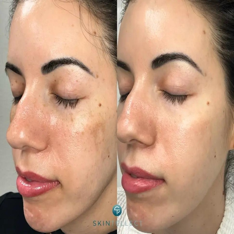 hollywood_spectra_ Hollywood Spectra before and after pigmentation and skin brightening results