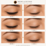 Laser eyeliner removal before and after results NZ clinic