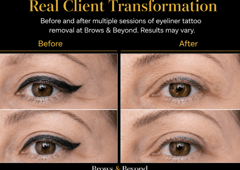 Laser eyeliner removal Auckland - before and after results at Brows and Beyond NZ