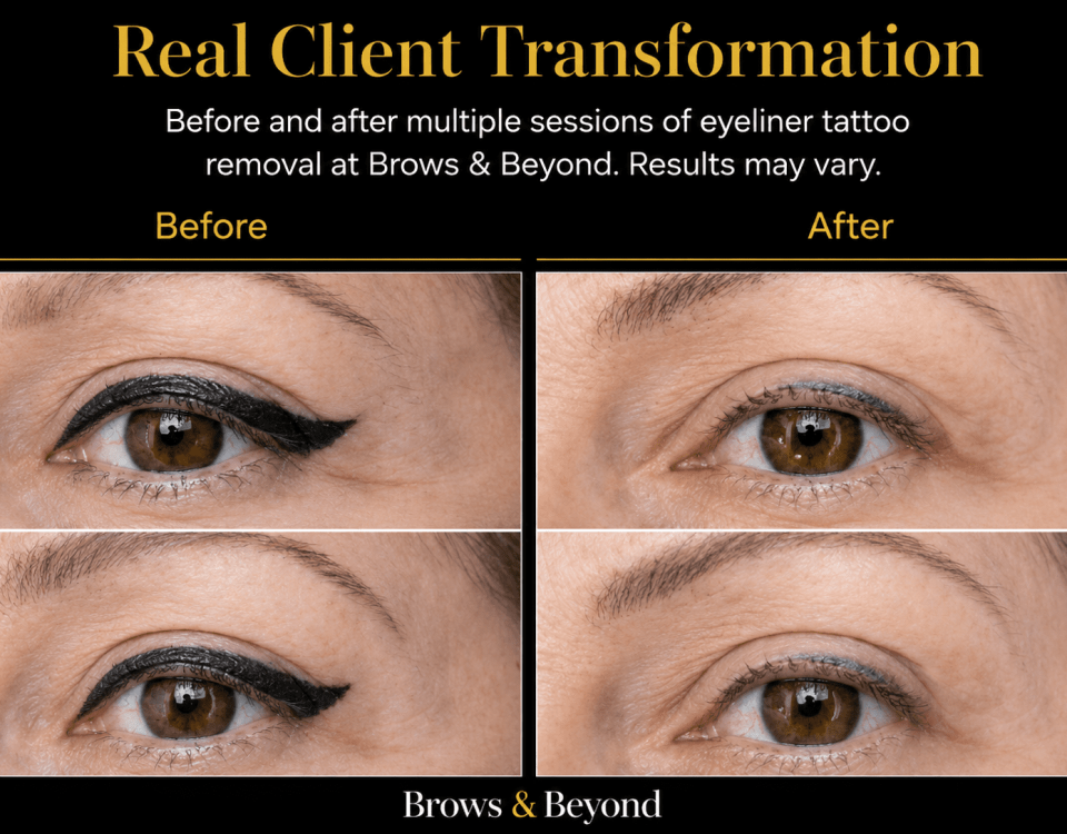 Laser eyeliner removal Auckland - before and after results at Brows and Beyond NZ